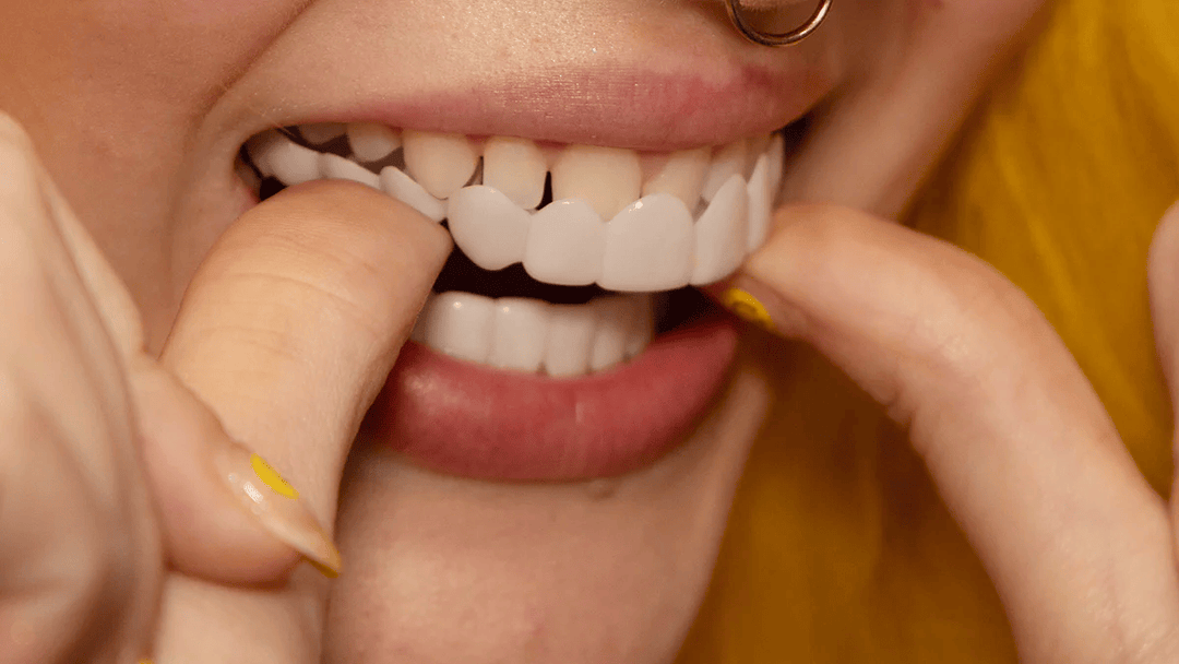 Close-up of Instant Natural Smile Veneers for both upper and lower teeth, showing natural design.