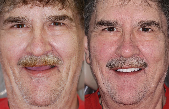 Enhance your smile with personalized full dentures, natural ivory & white teeth, offering comfort and a secure fit.