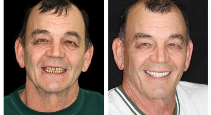 Unisex personalized full dentures, natural look ivory & white teeth, ensuring a comfortable, confident, natural smile.