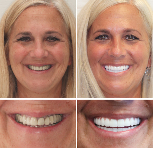 Unisex personalized full dentures, natural look for dental health & a radiant ivory & white smile.