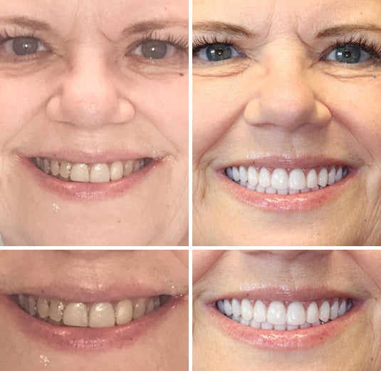 High-quality personalized full dentures, ivory & white teeth, designed for natural appearance & comfort.
