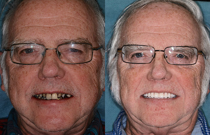 Personalized full dentures, natural ivory & white teeth, offering comfort and a radiant, natural-looking smile.