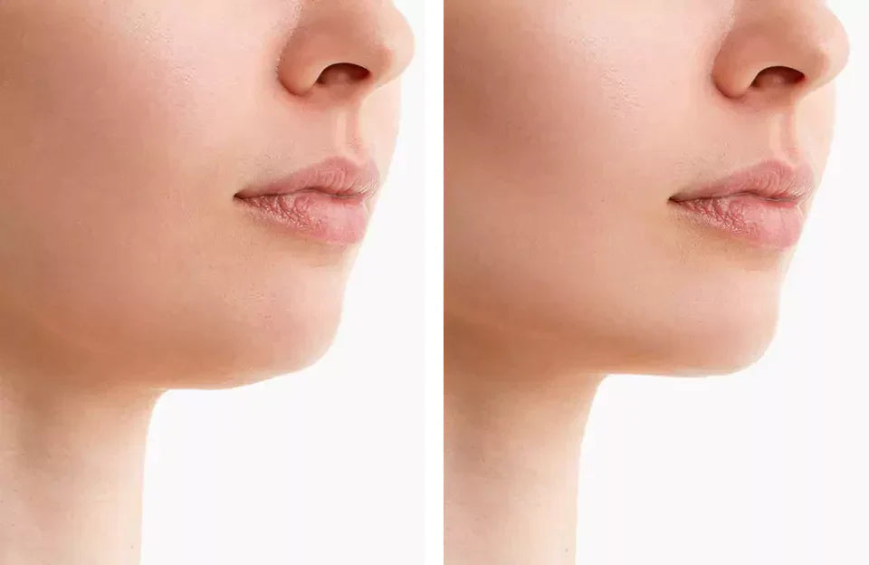 Chin & jaw contouring red light therapy belt. Effectively reduces double chin, tightens skin, creates V-line.